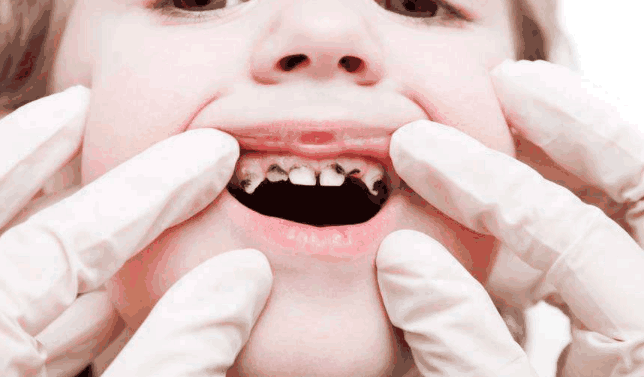 8岁男孩牙齿变黑坏了,医生检查后说出原因,爸爸打了妈妈一巴掌