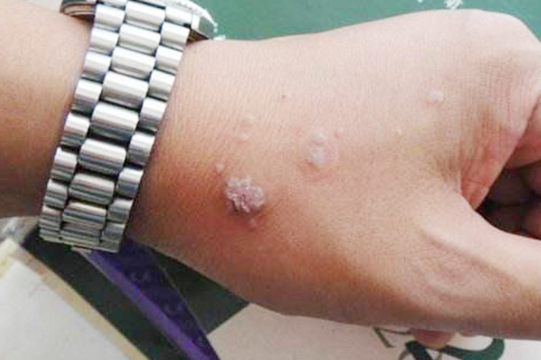 身上突然长出了一粒粒的"肉疙瘩",是怎么了?会发生癌变吗?