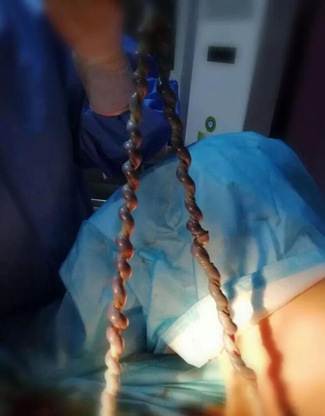 有惊无险!脐带扭转48圈的"麻花"宝宝在临汾妇幼保健院顺娩