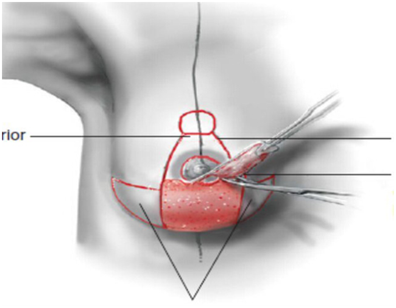 乳房下垂矫正术图片