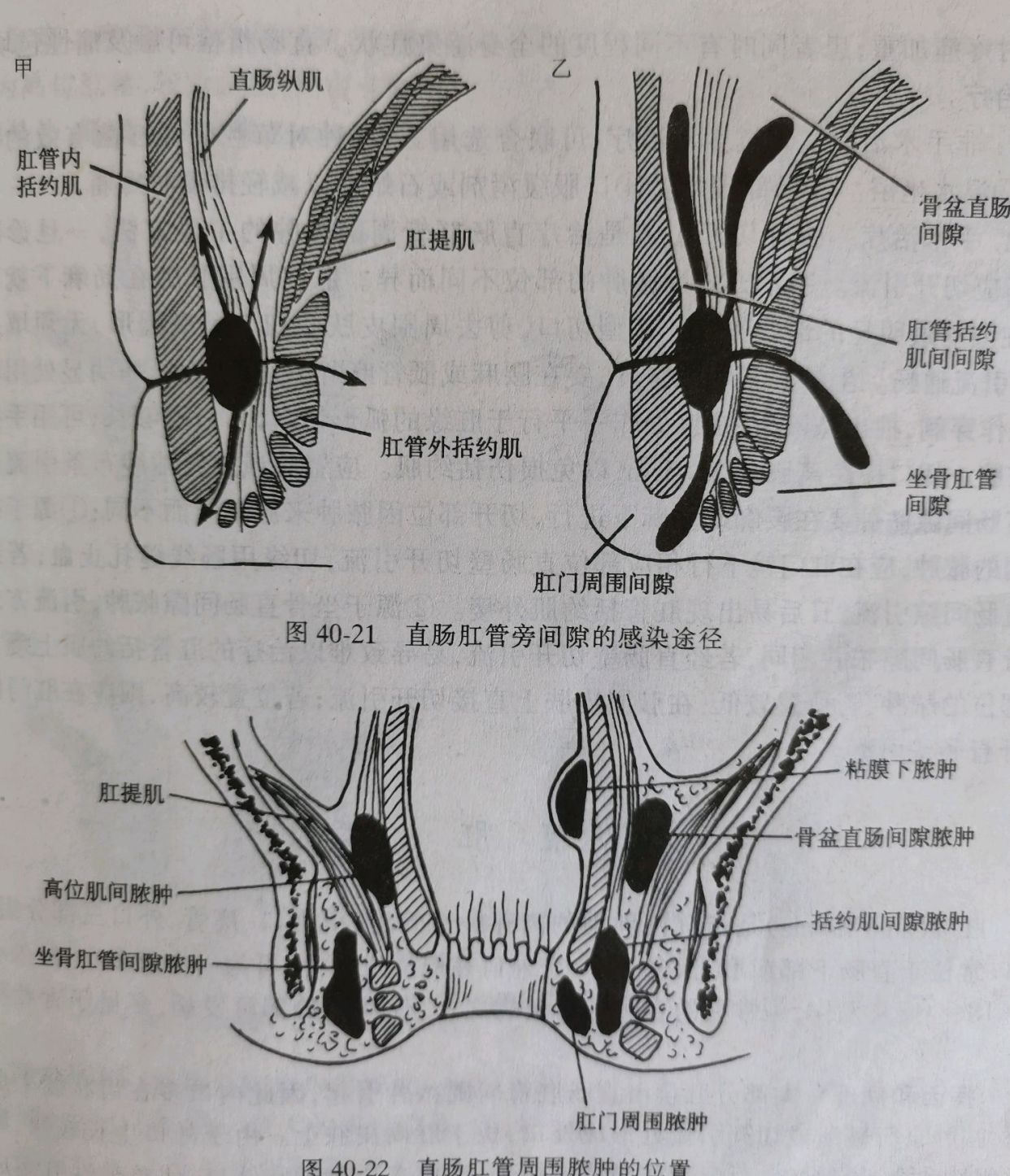 什么叫肛瘘图解图片