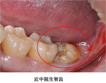 智牙正常图片图片