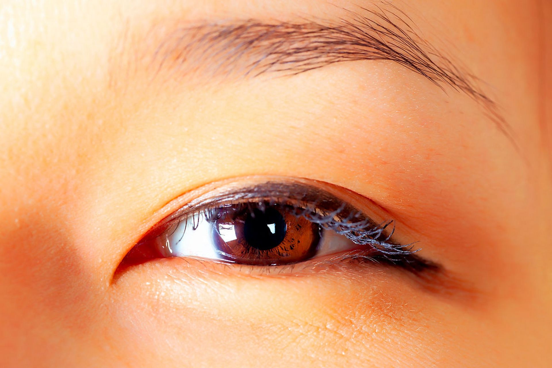 什么是假性双眼皮?