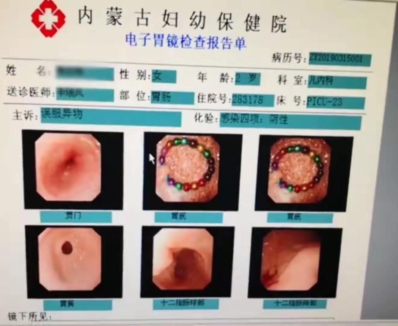 磁力珠吞到肚子里怎么办_磁力珠吃到肚子里怎么查抄
（磁力珠吞进肚子怎么办）