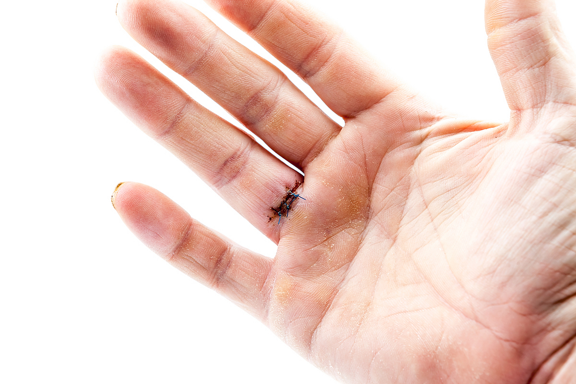 右手虎口肌肉萎缩是什么原因	右手虎口肌肉萎缩可能是长期不用右手