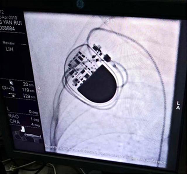 衡陽縣人民醫院完成一例永久性人工心臟起搏器植入術