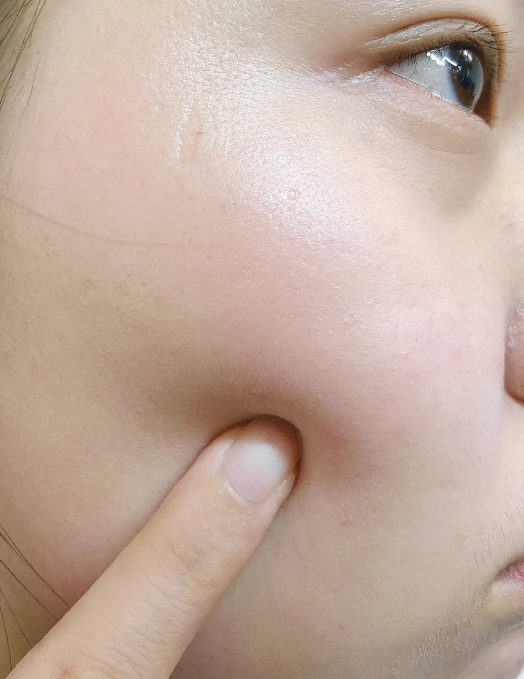 眼睛下面长鸡皮疙瘩怎么办(眼周围长小疙瘩像鸡皮能去除吗)