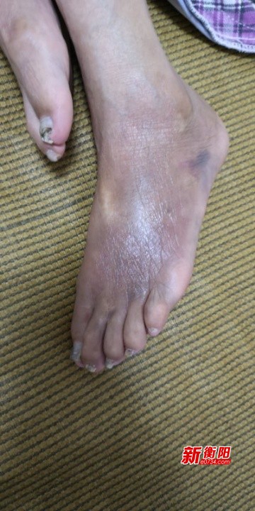 谁之过?91岁老人入住老年公寓左手骨折浑身淤伤