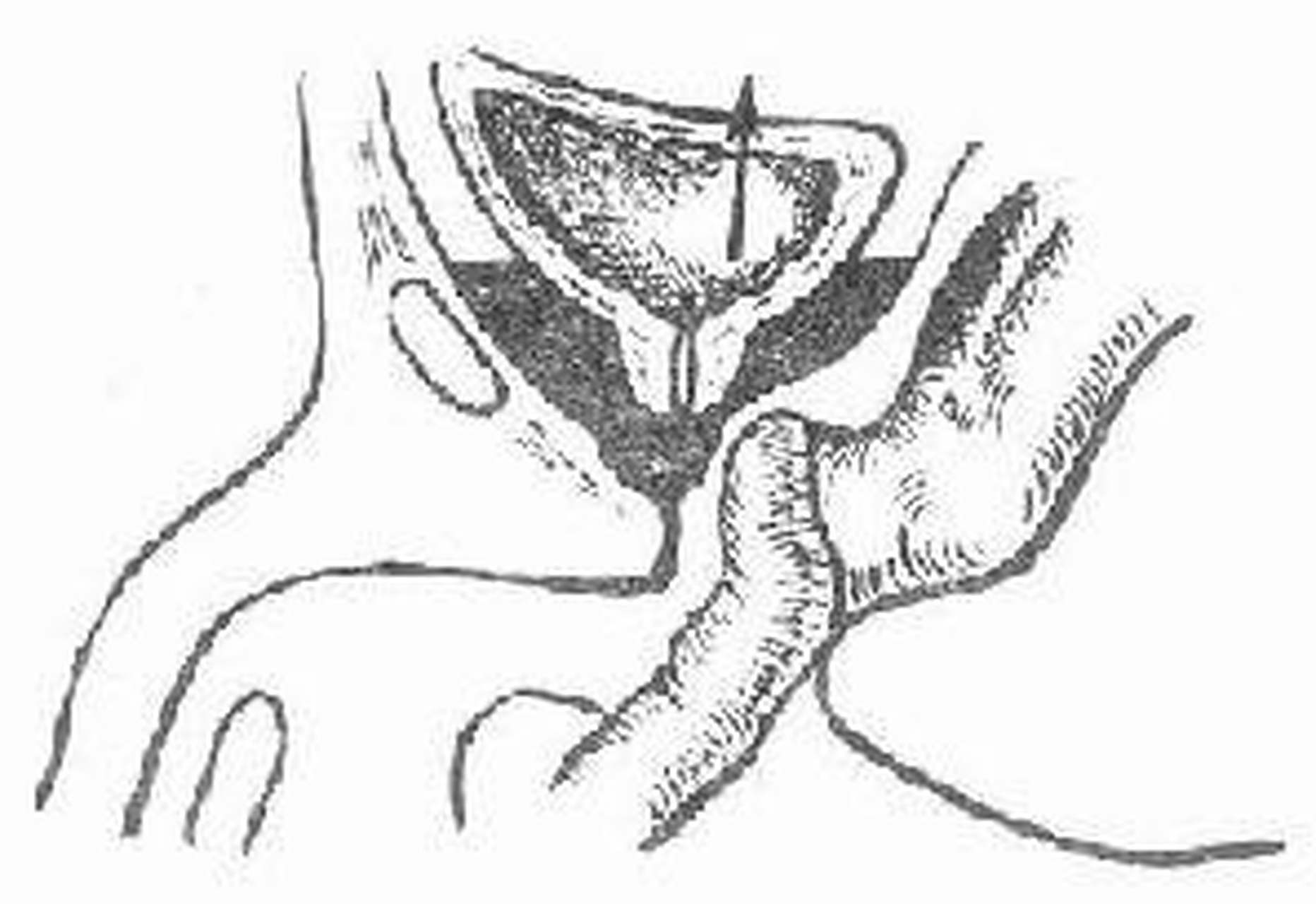 科普知识竞赛#前列腺直肠指检为bph最简单且必须要进行的检查方法