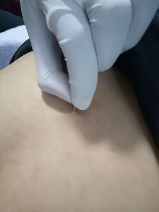 民间绝技挑羊毛疔