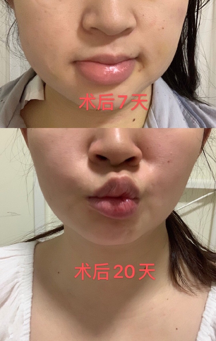 女子面部吸脂手術後嘴巴歪了,醫院聲稱:術後併發症,是正常現象