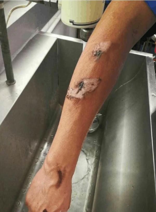 知名明星徒手拖出着火煤气罐,手臂被烧伤 ,模范李易峰!