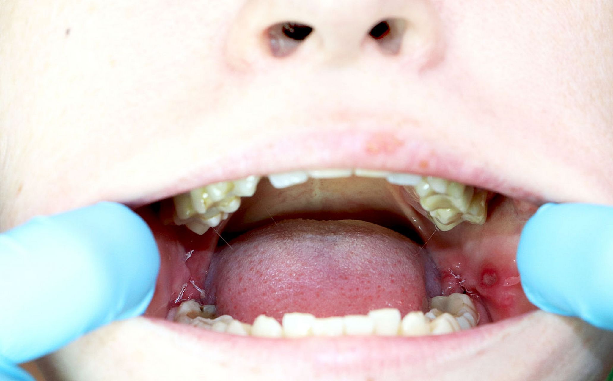 宝宝满月长了鹅口疮,用制霉素片后好转了,但是停药就又长了,反反复复