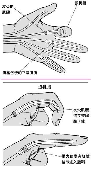 先天性拇指狭窄性腱鞘炎一定要手术吗?2岁以内可以保守治疗!