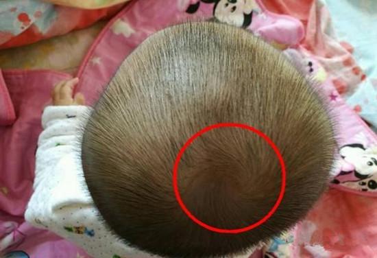 孩子头"旋"个数不一样,跟孩子发育和健康有关?家长要知道事实