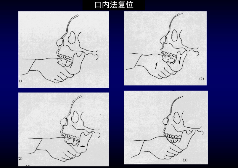 颞颌关节脱位手法复位图片