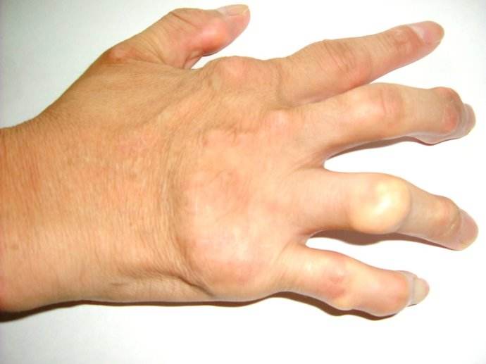 手关节痛风的症状图片图片