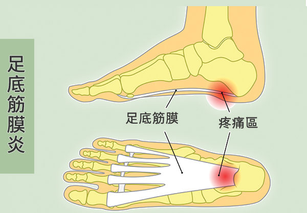 脚踩地像针扎?3招改善足底筋膜炎 跟脚痛拜拜