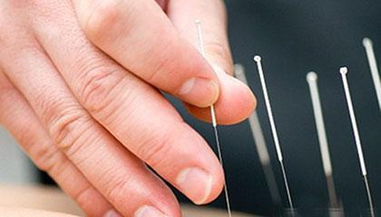 中医:鼻炎反复发作,用针灸治疗有没有用呢?