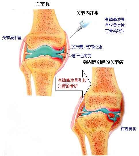 四川赫爾森康復醫院-骨性關節炎的症狀特點和體徵