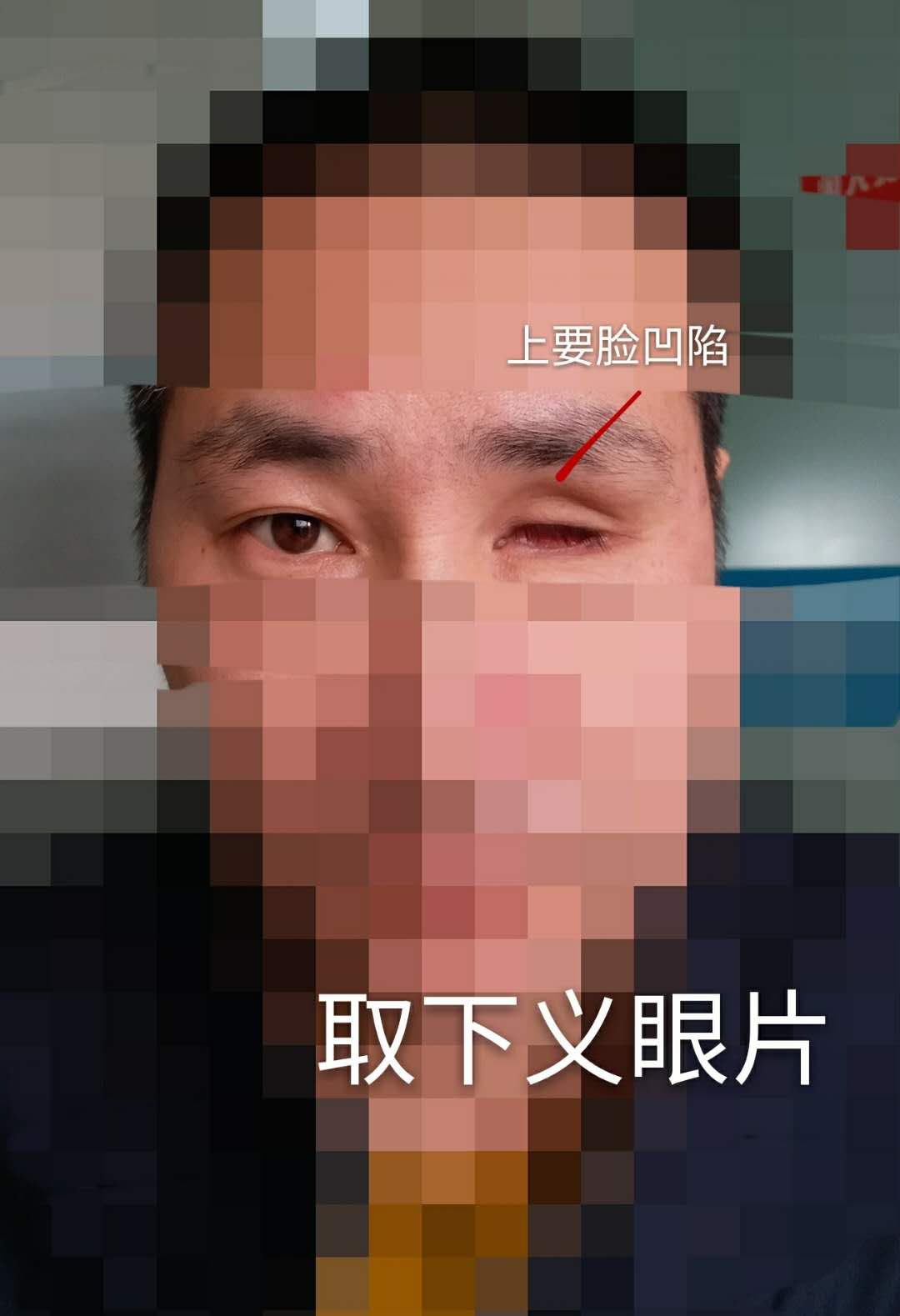 为什么说摘除眼球后第一个义眼片至关重要?