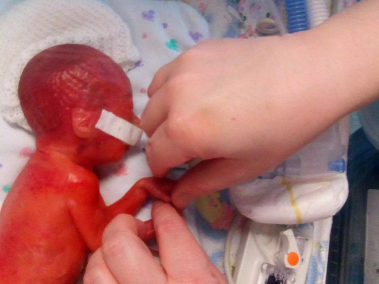 年轻产妇怀孕23周就生下女儿,宝宝身体发红像外星人