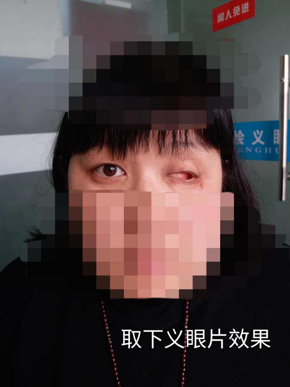 双绘义眼案例解析