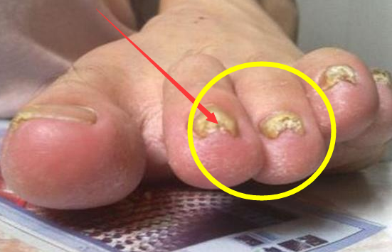 体内有没有血栓,看看手和脚有没有这3个症状,别傻傻地不知道