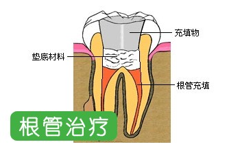 根管治疗疼不疼图片