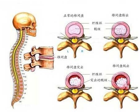 腰间盘突出引发"坐骨神经痛":一套伸筋操,腿疼腿麻时效果好!