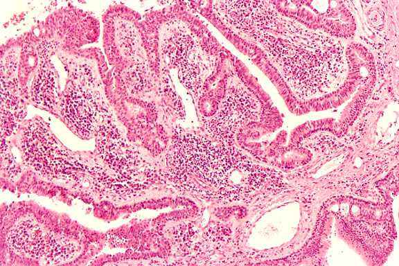 科普篇 | 宫颈癌免疫组化报告怎么看?p16,ki67是什么意思?