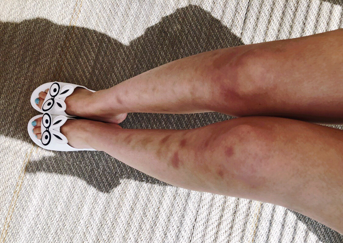 林允晒腿是招黑呢,还是洗白呢?还是