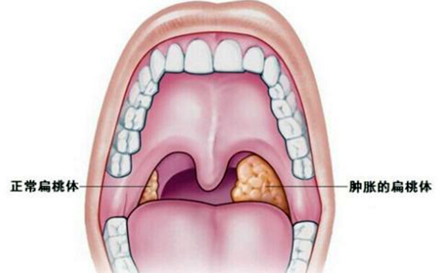张开嘴看你咽喉有水泡没,扁桃体和淋巴你清楚吗?很多人都分不清