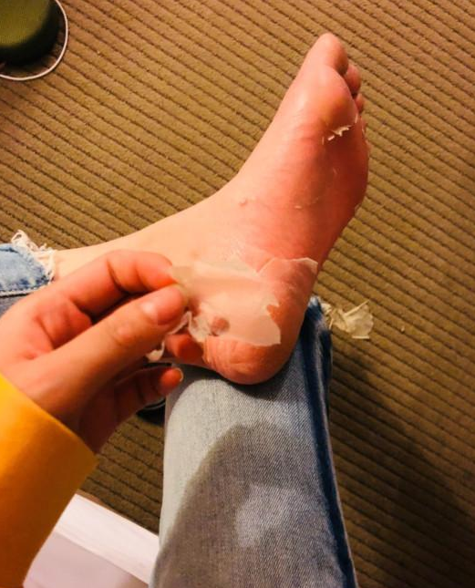 慎点!林允深夜微博晒撕脚皮照,网友:不愧是社会我费霞姐