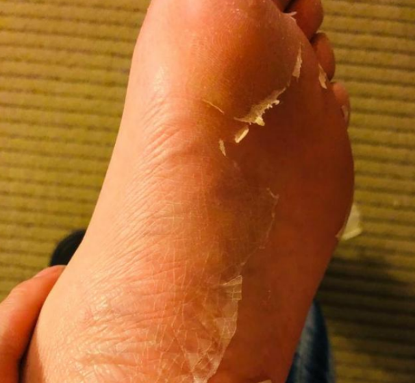 林允微博公布私密足照,脚底"爆皮"引人心疼!