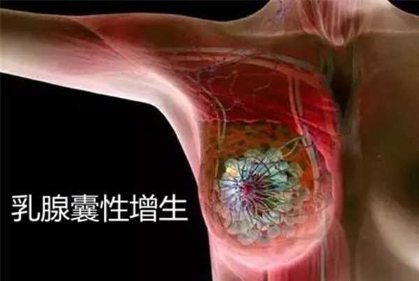 乳腺囊性增生到乳腺癌,都有这7个症状,你注意到了么?