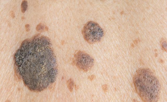 黑色素瘤就要夺走我25岁的生命吗?痣与黑色素瘤的4点区分5点重视