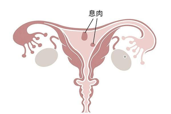 宫颈息肉图片症状图片