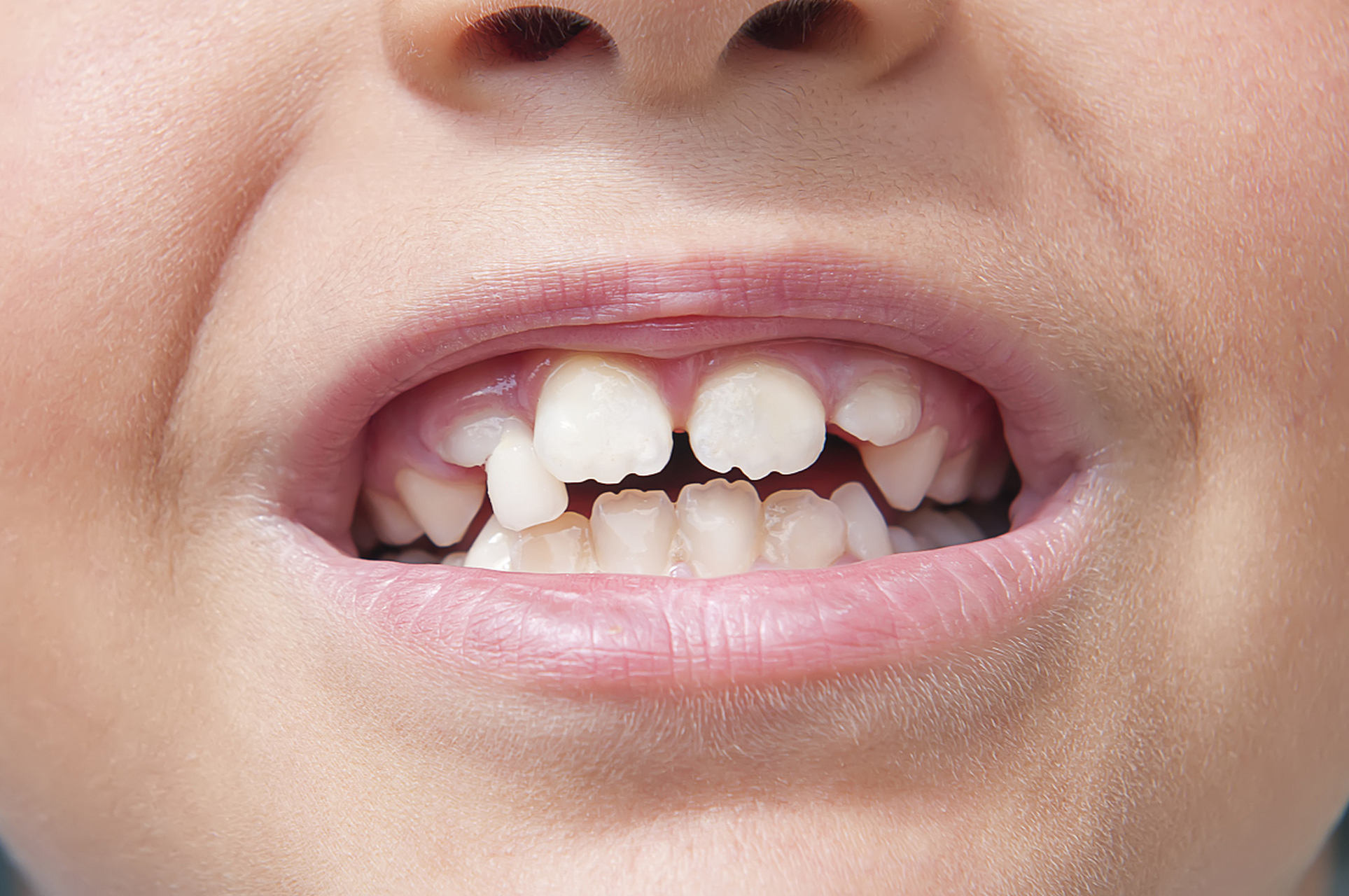 儿童牙齿不齐,这是一个常见的问题,但也是一个需要及时矫正的问题.