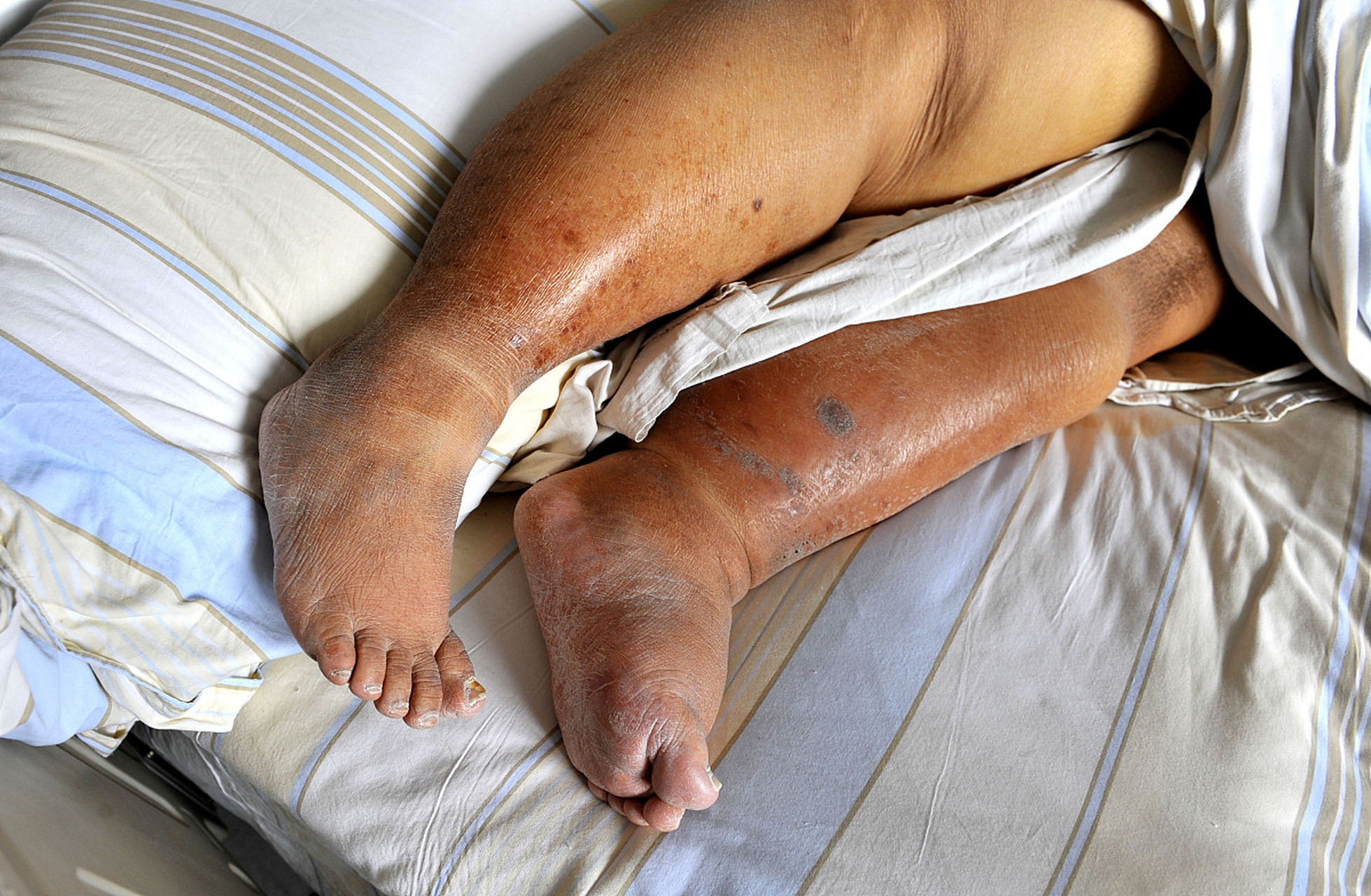 1,皮肤护理:褥疮是因为患者长期卧床,皮肤受压的