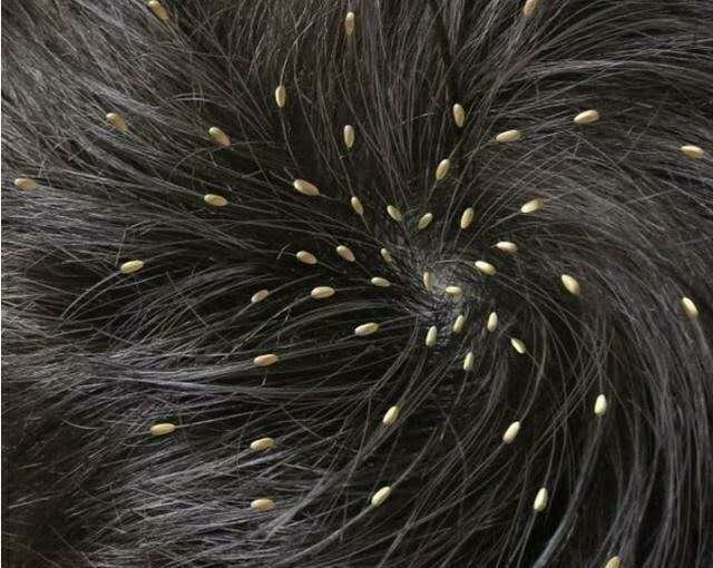 六,七,八十年代,人身上为什么会生虱子?