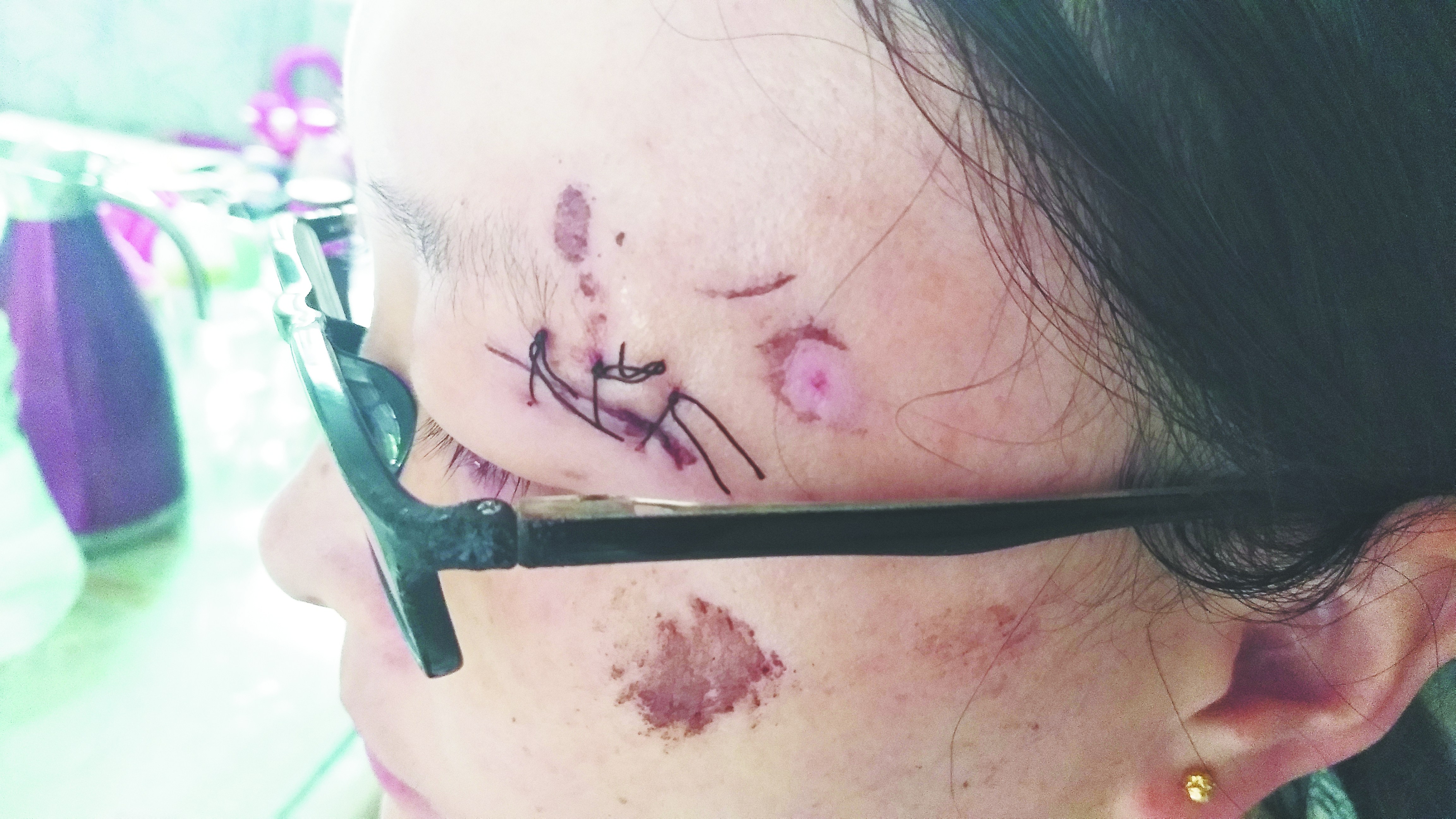 路边联通光缆垂落 淄博2人接连摔倒受伤