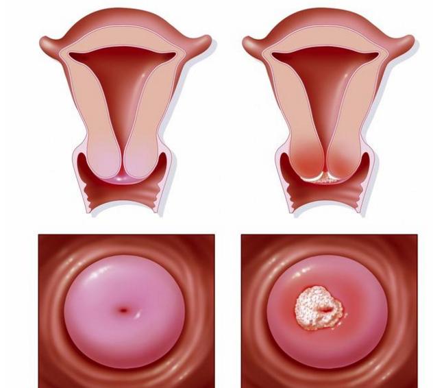 宫颈癌图片早期 晚期图片