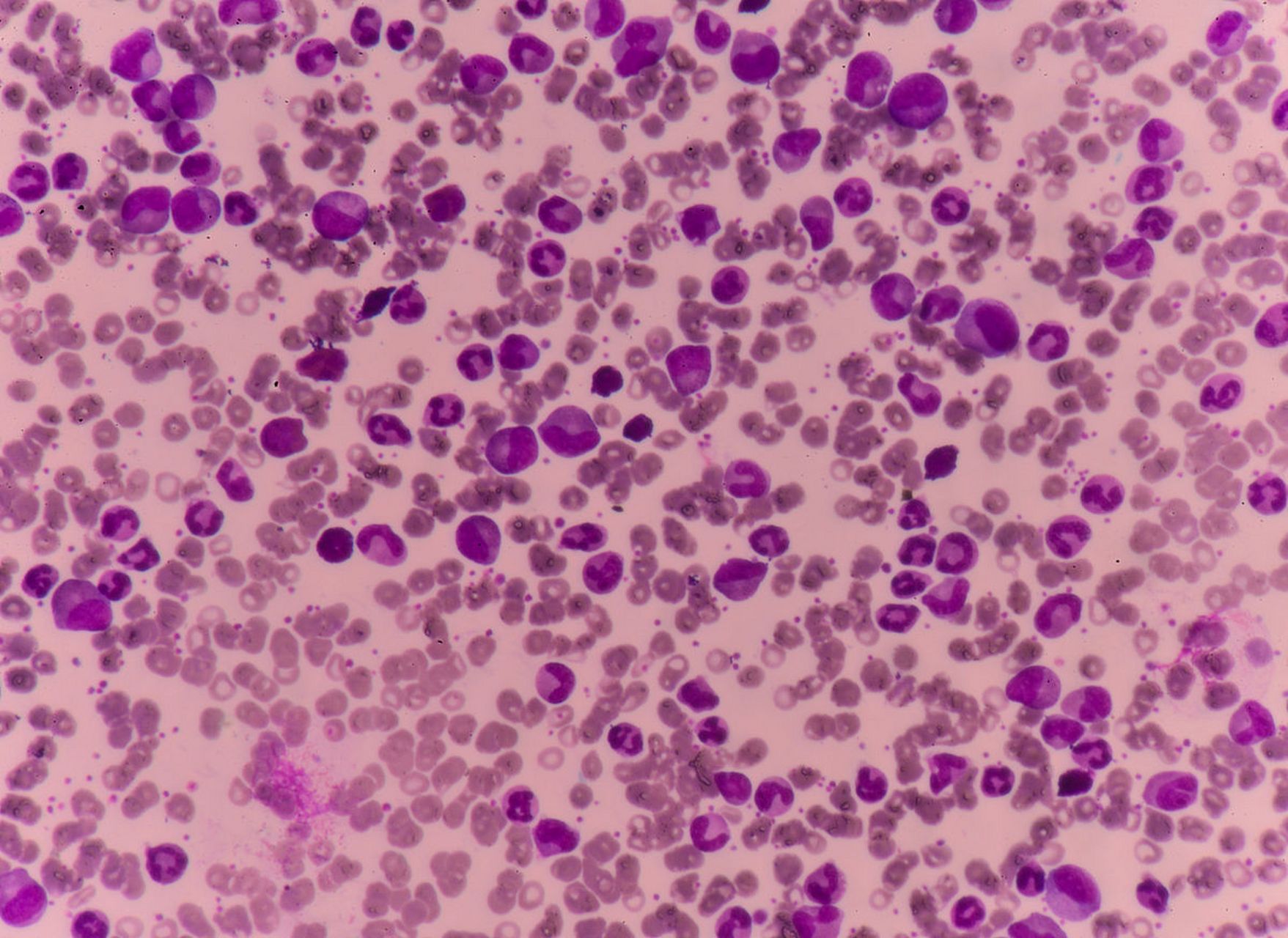 有些人认为,肺炎支原体感染存在季节性高峰,每隔3-5年就会迎来一次