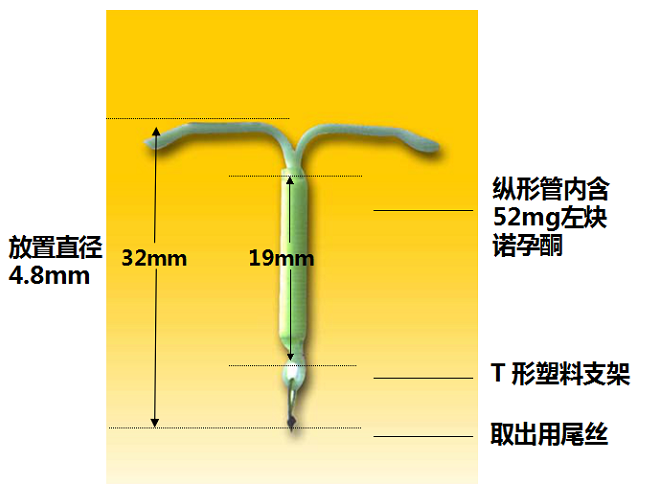 新型節育環or新型避孕微針貼片,哪種才是最