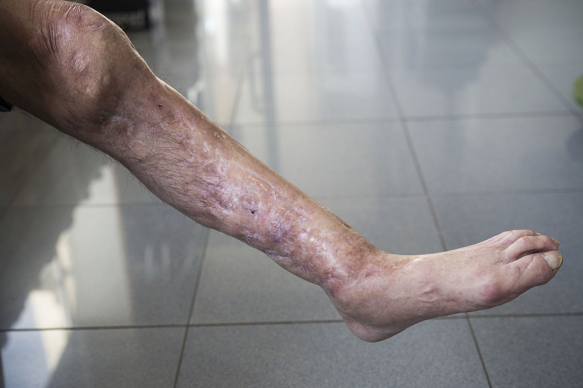 当压力来敲门# #血管炎#   血管炎的患者是不可以游泳的.