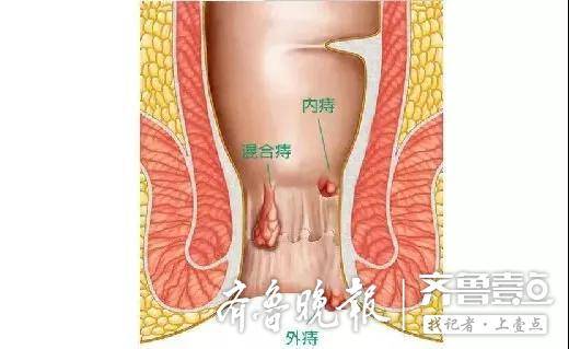 滨州市人民医院消化内镜微创治痔疮,手术费用低,恢复快,痛苦小