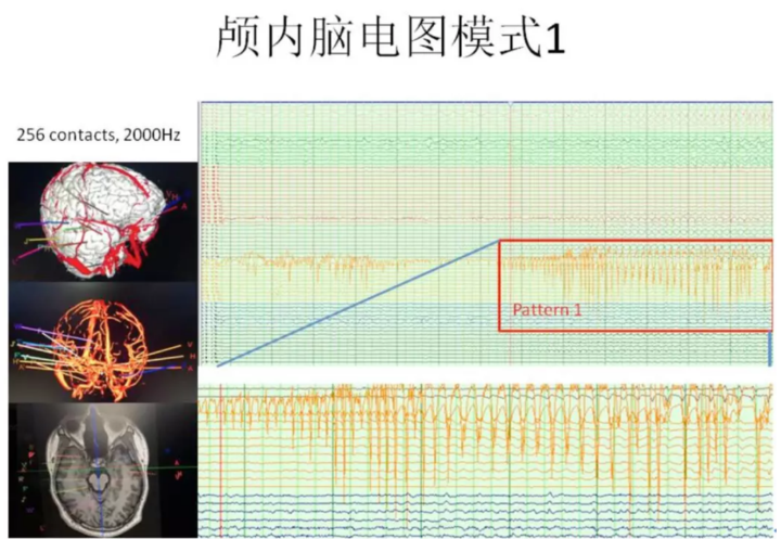 脑电图的定位方法图片