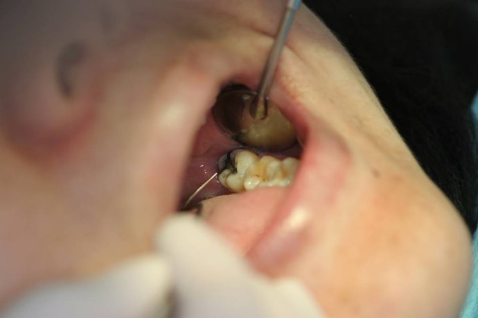 拔牙后脸肿了是冷敷还是热敷?