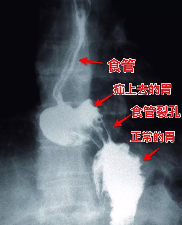 食管裂孔疝是什么病?有哪些症状呢?不妨进来看一看!